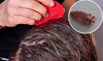 Do You Have Lice? How to Check and What to Do Next